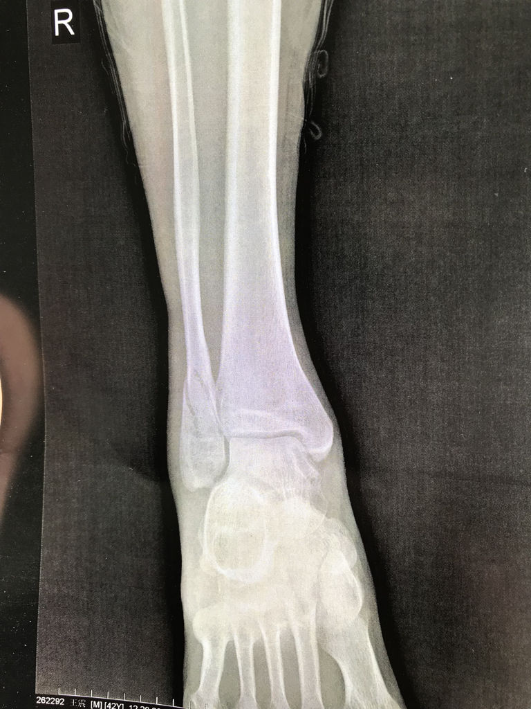 这样骨折大概多久可以走路啊