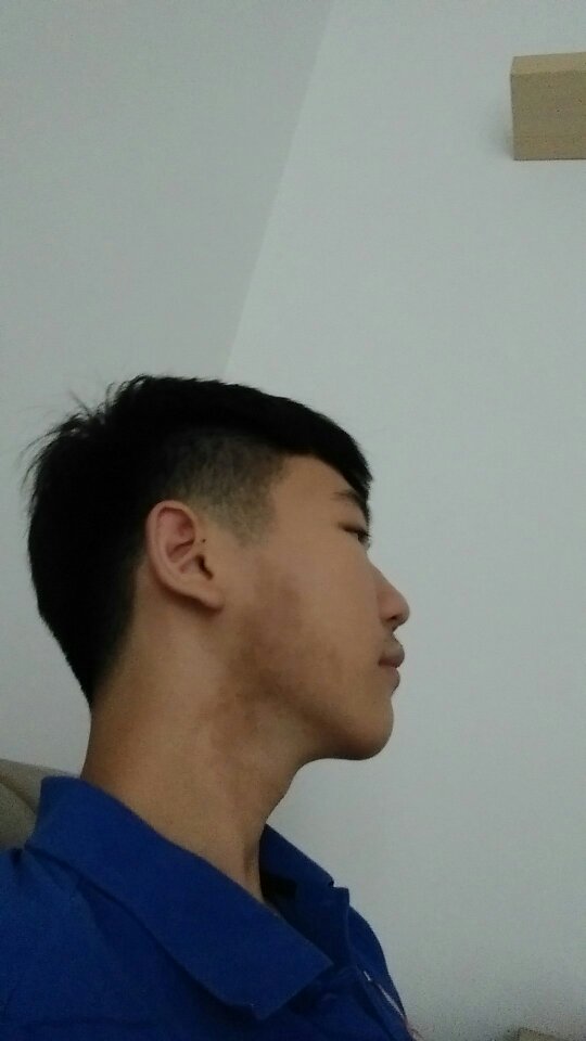 我的脸右边有块黑色素沉淀怎么办