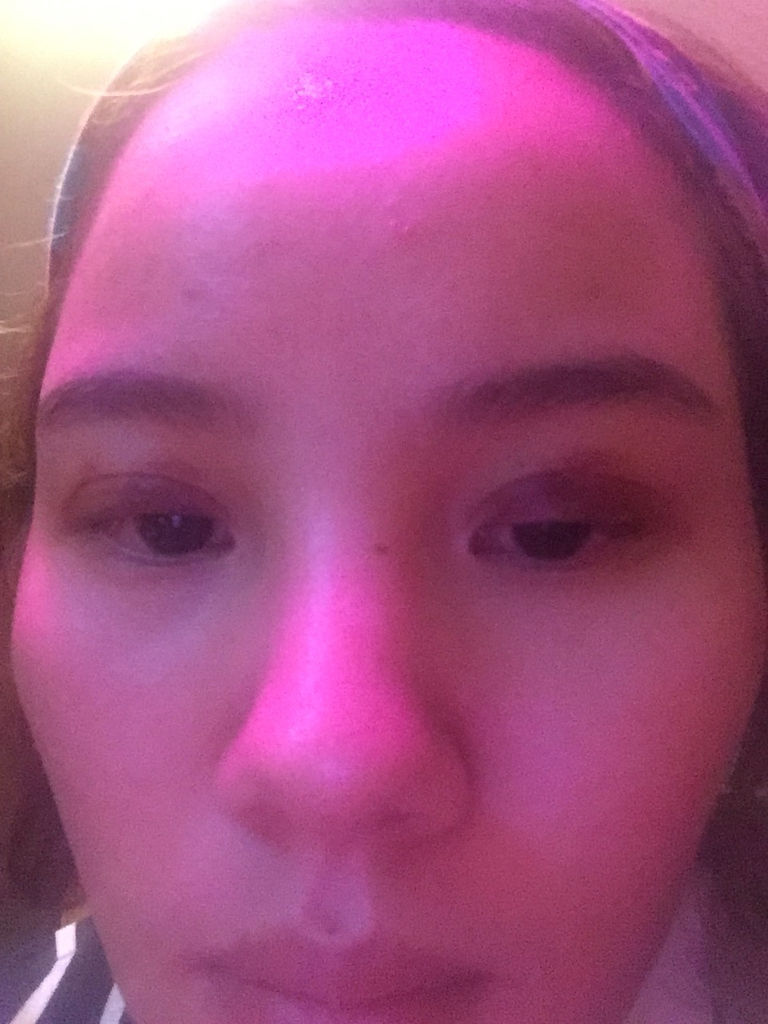 双眼皮埋线8天了还有瘀血怎么办
