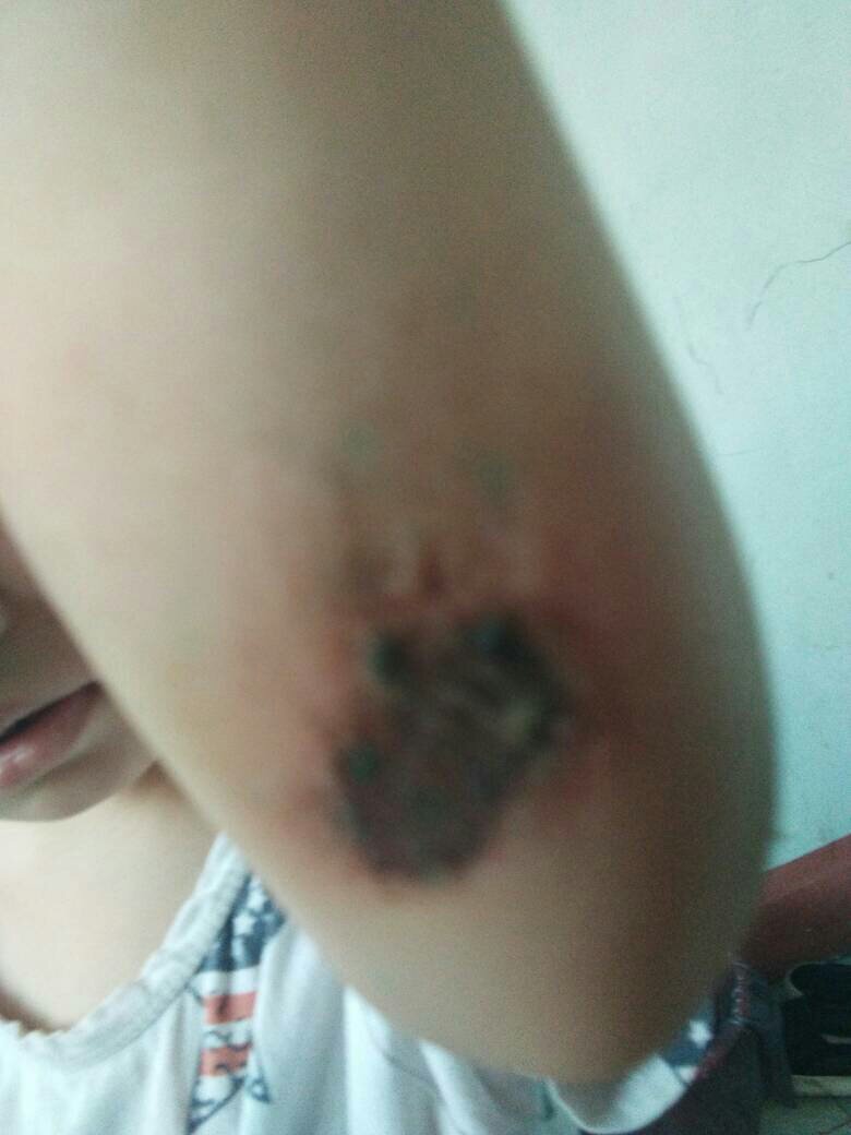 前几天孩子摔倒了,胳膊肘破皮了,我也没管,昨天上午有