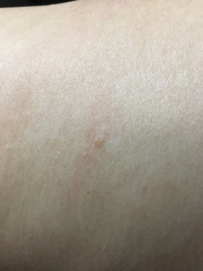 背上长了一小串硬的颗粒物,摸着就像干了的疤一样