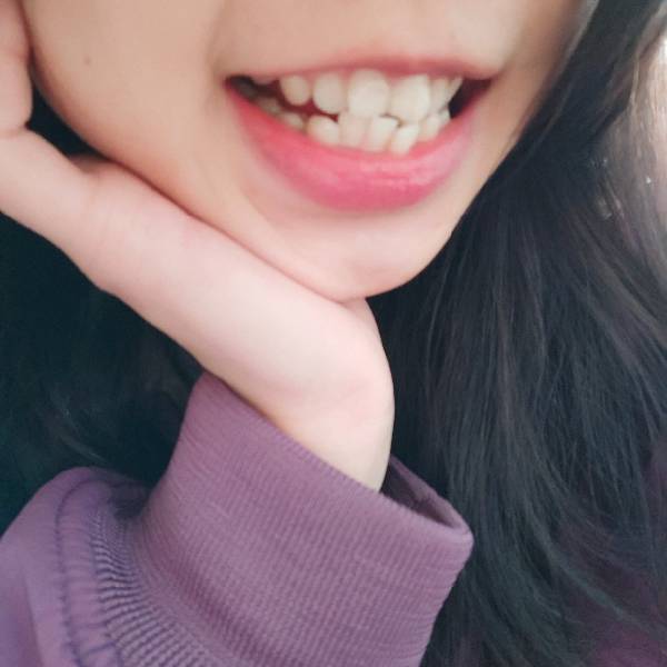 请问这是齿性龅牙还是骨性龅牙呢?