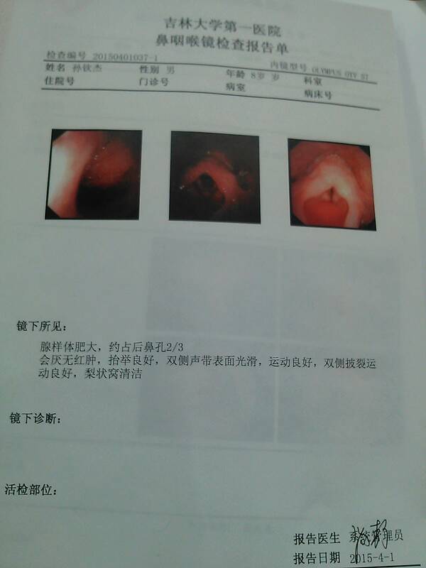 男孩六岁半腺样体肥大约占后鼻孔三之二,会厌无红肿抬举良好双侧声带