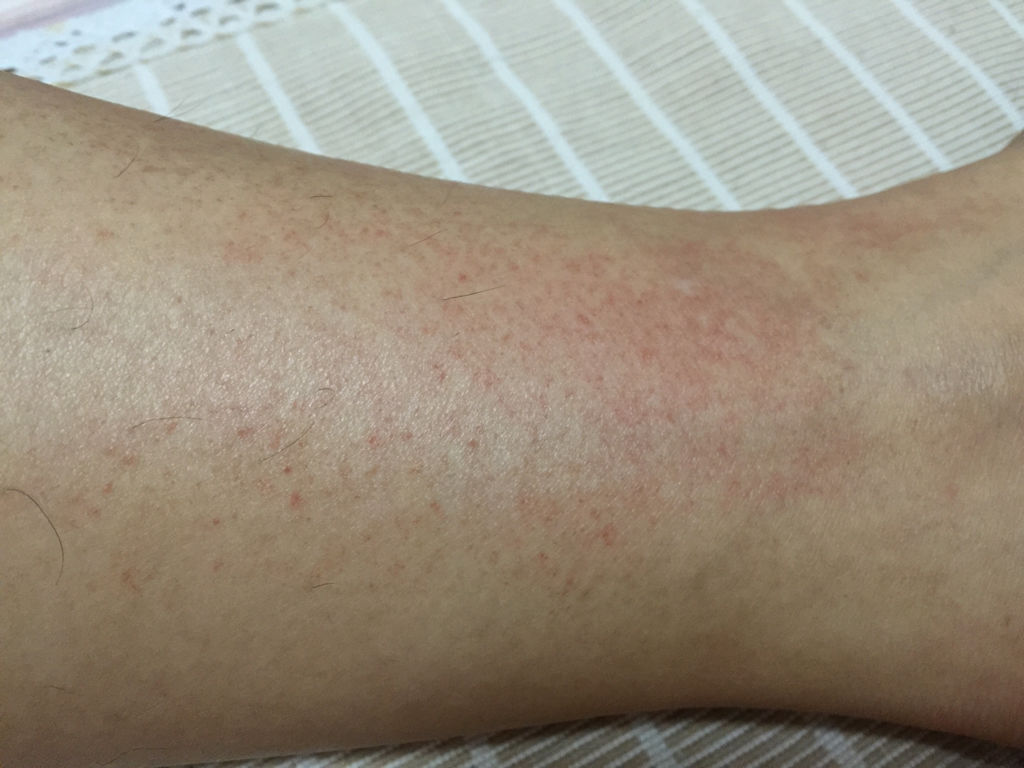 腿上突然起了很多血点,不疼不痒,也摸不出起伏来.七八