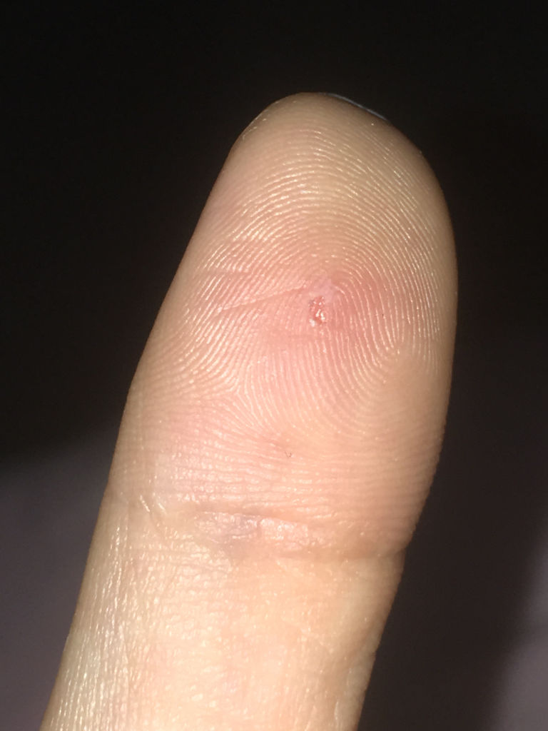 一到夏天手指头上就出水泡,有点疼,必须弄烂了,才会慢慢好,大拇指就是