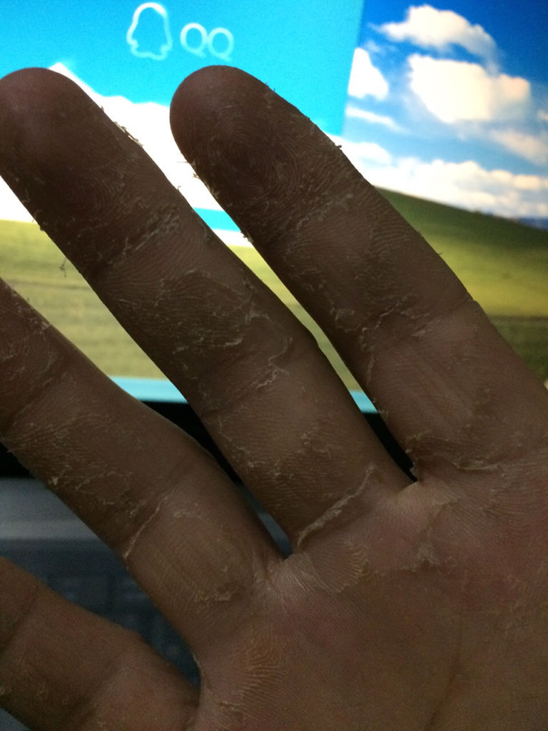 手气,真菌感染,前几天发现手上起小白点痘痘,还很痒,也没在意,结果几