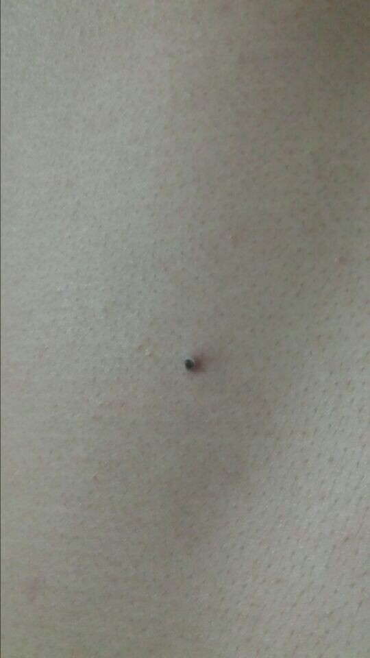 背后突然长了一颗黑色状的痘痘!希望老师们帮帮我