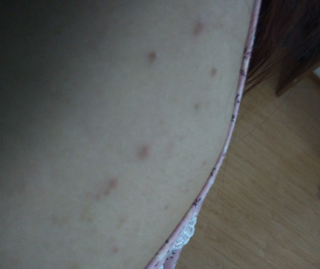 后背有痘印怎么穿婚纱_后背有痘印是什么原因(2)