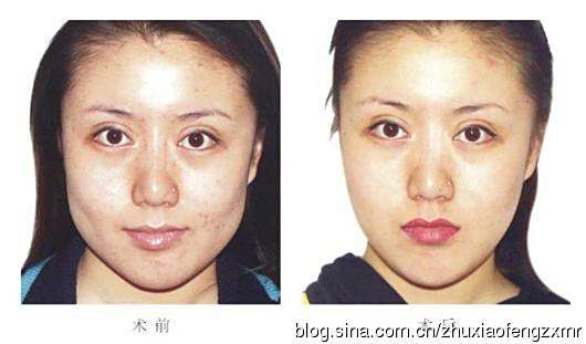 瓜子脸男性瞳距多少,瓜子脸男性瞳距多少算正常