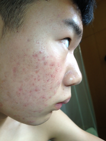 脸上长痤疮图片_脸上长痤疮怎么办
