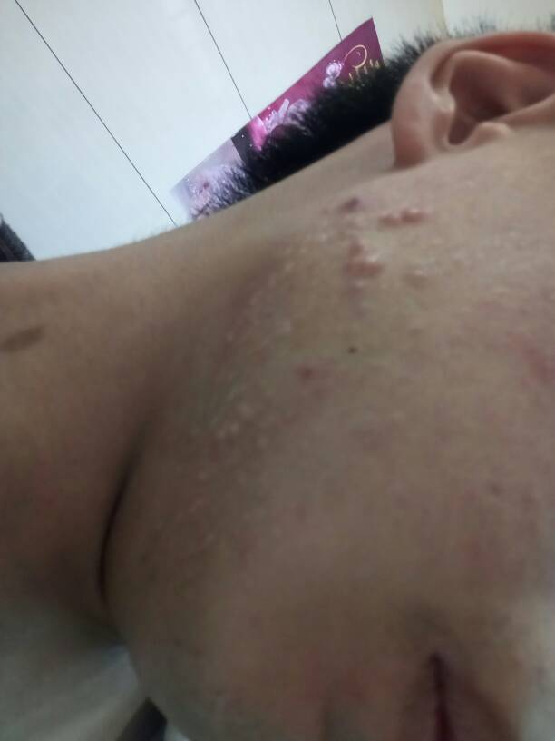 脸上长痤疮图片_脸上长痤疮怎么办