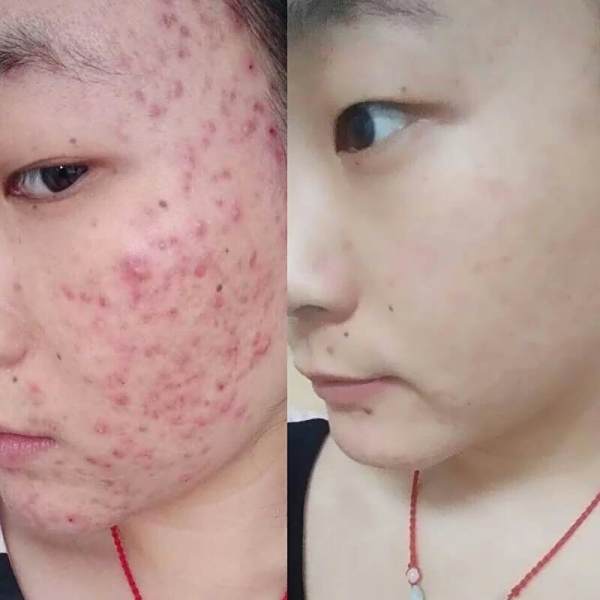 满脸青春痘怎么办