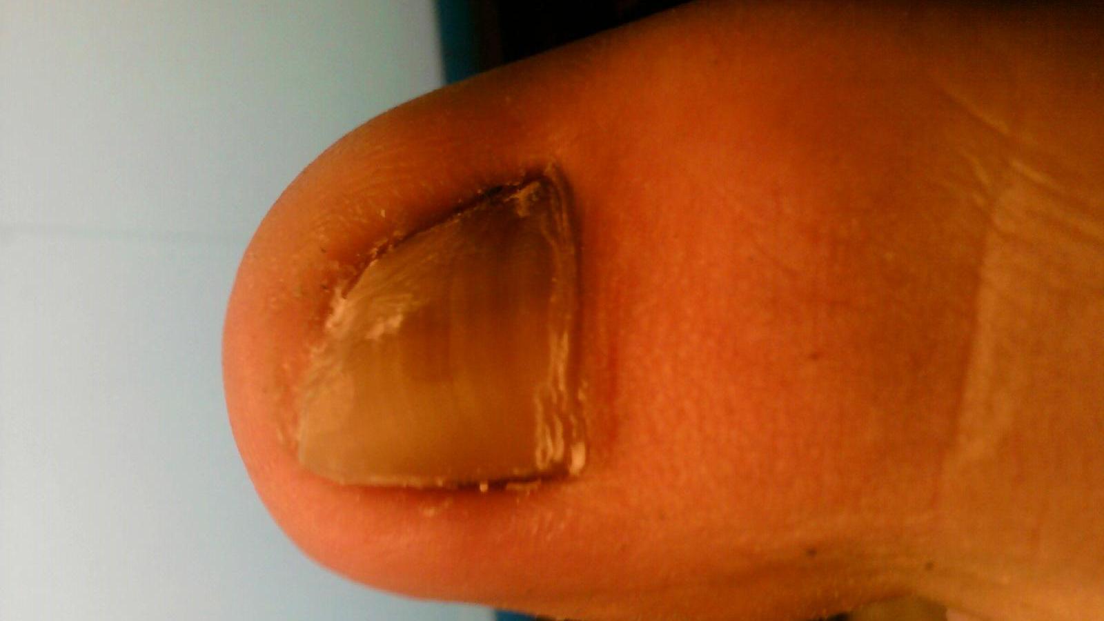 嵌甲是一种常见病,甲板侧缘长入附近的软组织中,像异物似的插入甲沟而