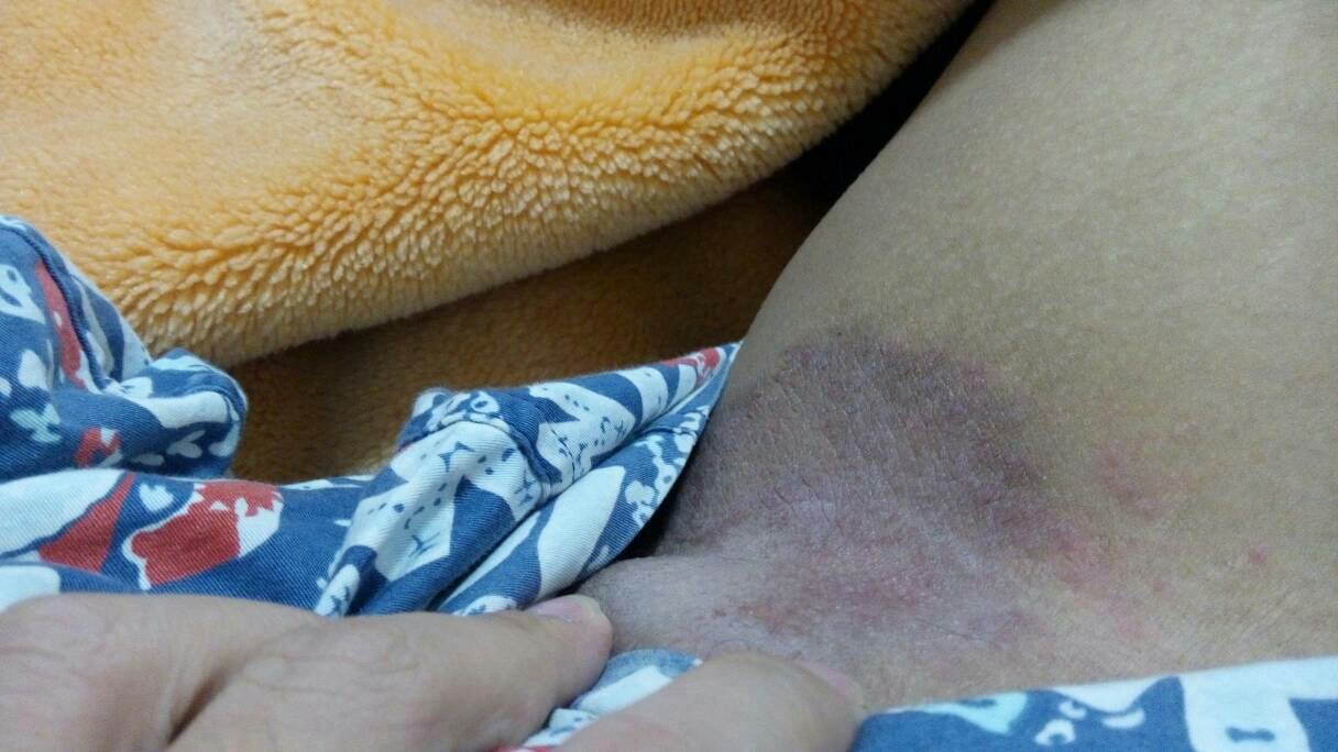 男性今年15岁 不知道长了什么 非常痒 每天都抓 越来越严重了 麻烦哪