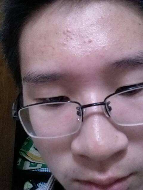 脸上长痘痘了怎么办