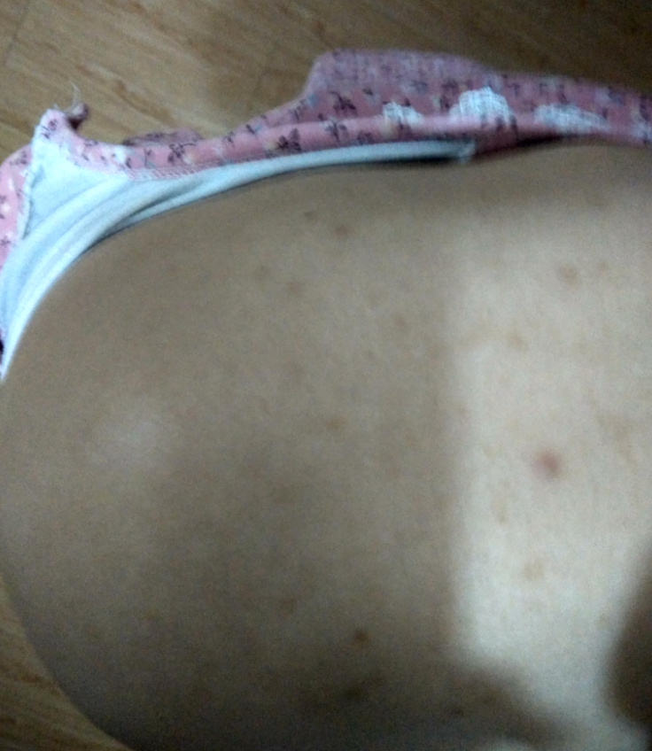 后背有痘印怎么穿婚纱_后背有痘印是什么原因(2)