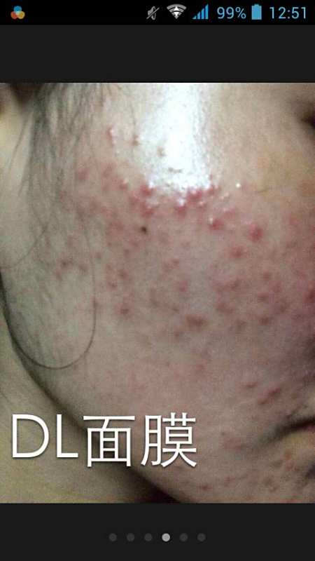 脸上长痤疮图片_脸上长痤疮怎么办