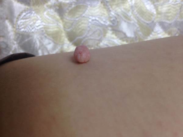 大腿上长了一个肉疙瘩,是什么呢
